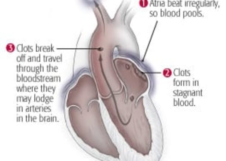 Patient Basics: Atrial Fibrillation