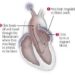 Patient Basics: Atrial Fibrillation