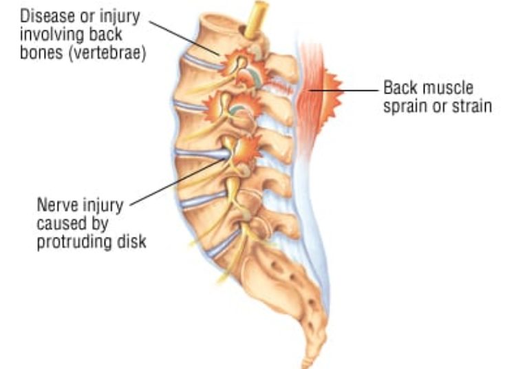 Patient Basics: Back Pain