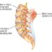 Patient Basics: Back Pain