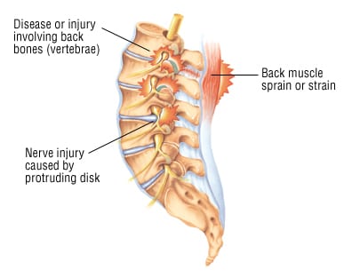 Muscular Back Pain vs Disc Back Pain - Spinal Backrack