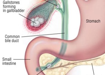 Patient Basics: Biliary Colic