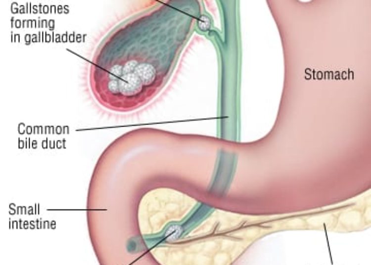 Patient Basics: Biliary Colic