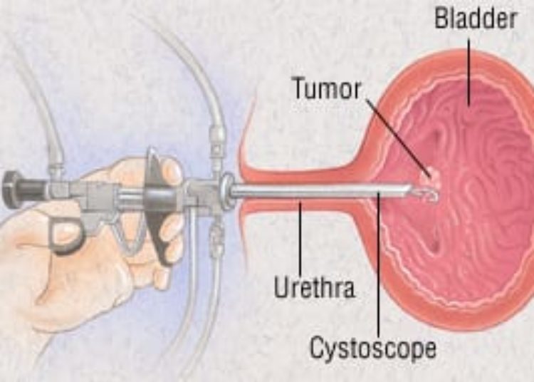 Patient Basics: Bladder Cancer