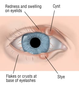 Blepharitis