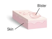 Blister (Overview)