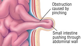 Bowel Obstruction1