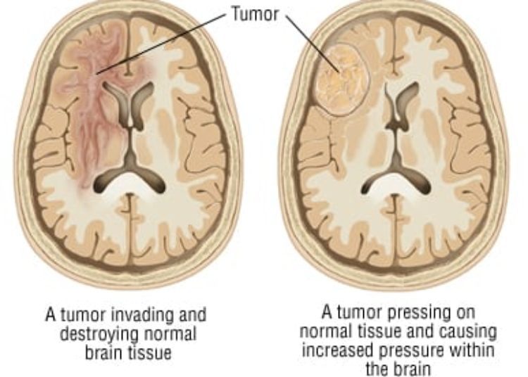 Patient Basics: Brain Tumor Overview