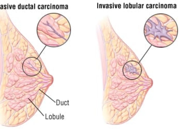 Patient Basics: Breast Cancer