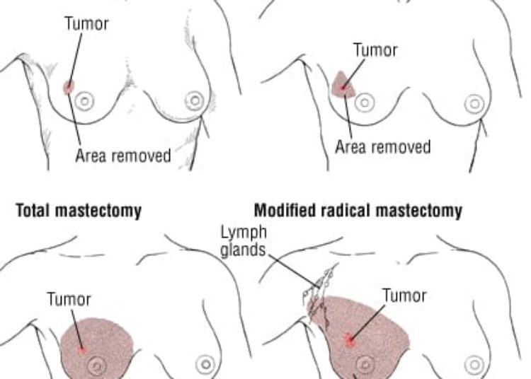 Patient Basics: Breast Cancer