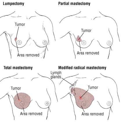 Cellular and hormonal content of breast nipple aspirate fluid in relation  to the risk of breast cancer