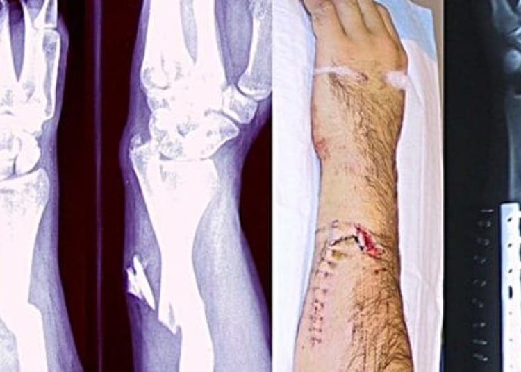 Atopic dermatitis linked with bone and joint injuries