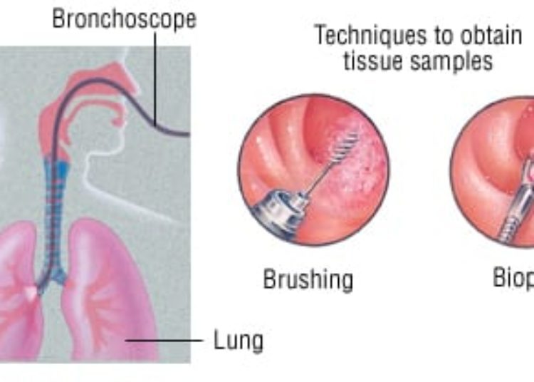 Patient Basics: Bronchoscopy