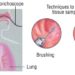 Patient Basics: Bronchoscopy
