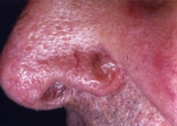 Patient Basics: Basal Cell Carcinoma