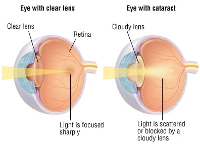 Patient Basics: Cataracts | 2 Minute Medicine