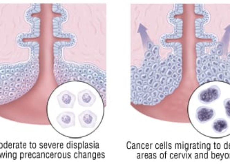 Patient Basics: Cervical Cancer