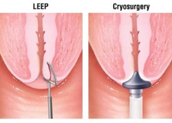 Patient Basics: Cervical Cancer