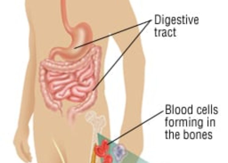 Patient Basics: Chemotherapy
