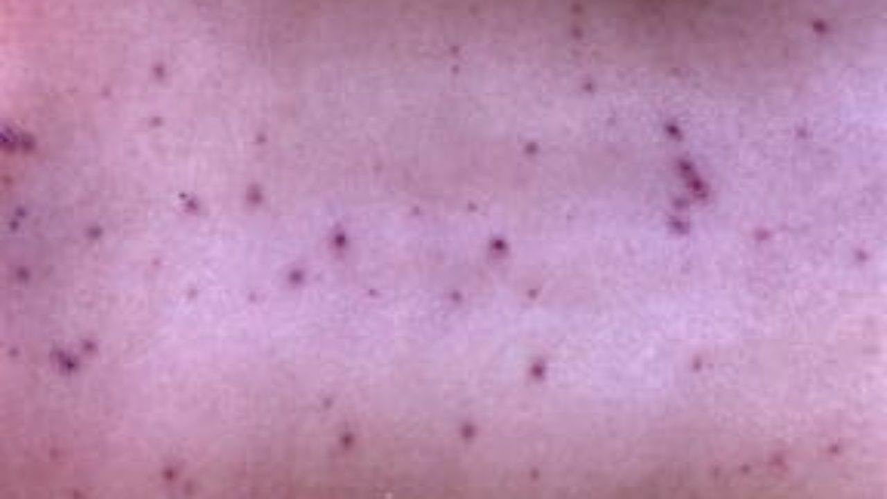 Patient Basics Chickenpox Varicella 2 Minute Medicine