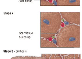 Patient Basics: Chronic Hepatitis