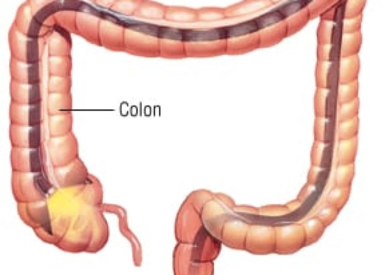 Patient Basics: Colonoscopy