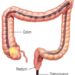 Patient Basics: Colonoscopy