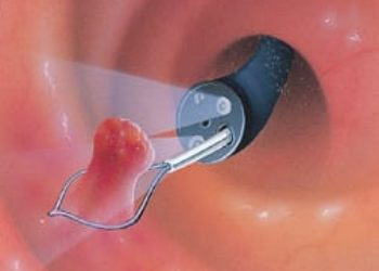 Patient Basics: Colonoscopy