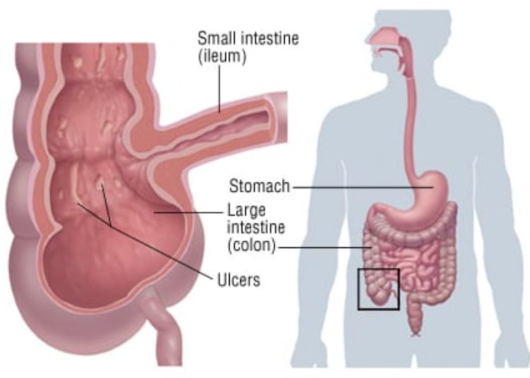 Patient Basics: Crohn’s Disease