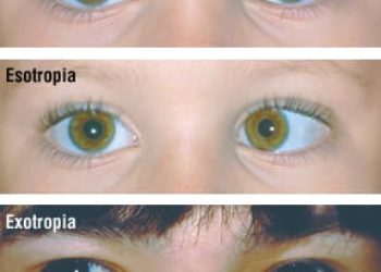 Patient Basics: Crossed Eyes (Strabismus)