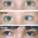 Patient Basics: Crossed Eyes (Strabismus)