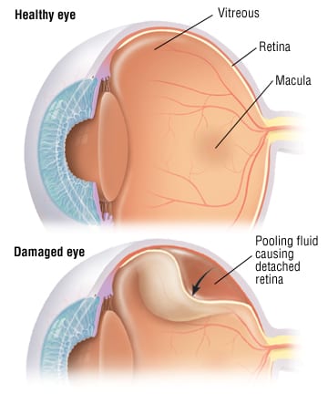 Can You Prevent and Treat Retinal Detachment?