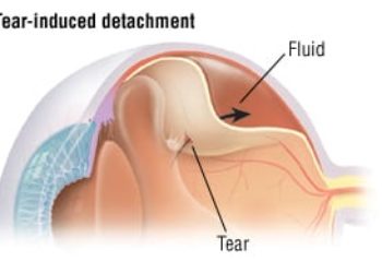 Patient Basics: Detached Retina