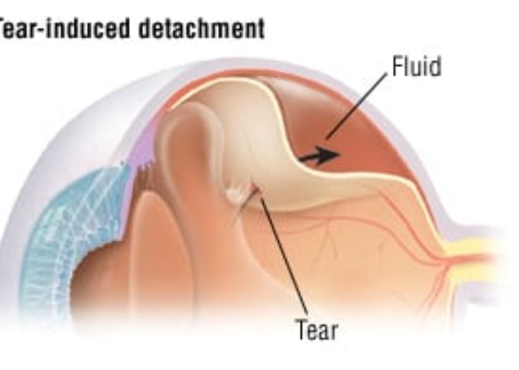 Patient Basics: Detached Retina