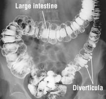 Patient Basics: Diverticulosis and Diverticulitis | 2 Minute Medicine