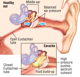 Patient Basics Earache 2 Minute Medicine