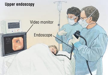 lower endoscopy procedure