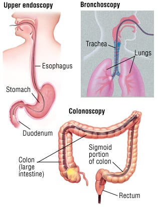 lower endoscopy procedure