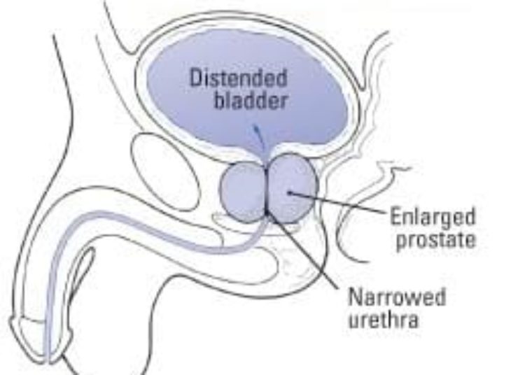 Patient Basics: Enlarged Prostate (Benign Prostatic Hyperplasia)