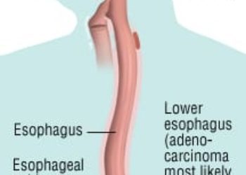 Patient Basics: Esophageal Cancer