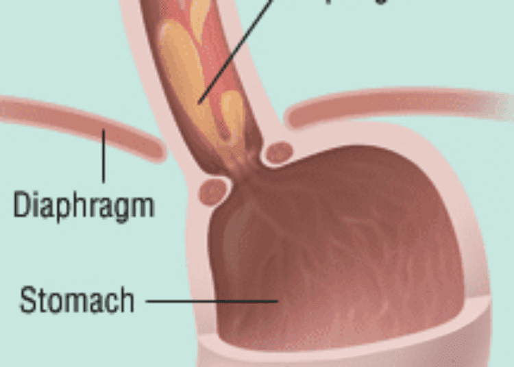 Patient Basics: Esophageal Cancer
