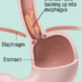 Patient Basics: Esophageal Cancer