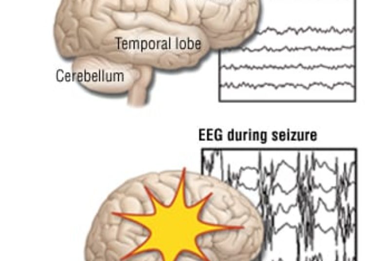 Patient Basics: Febrile Seizures