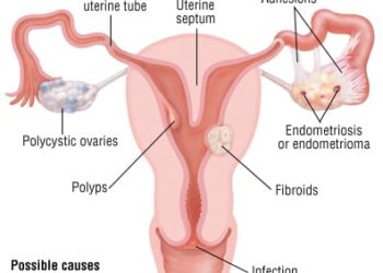 Patient Basics: Female Infertility