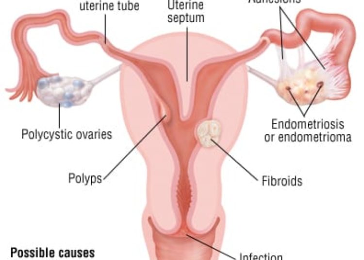 Patient Basics: Female Infertility
