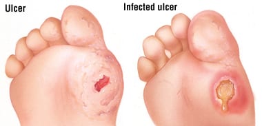 Foot Ulcers