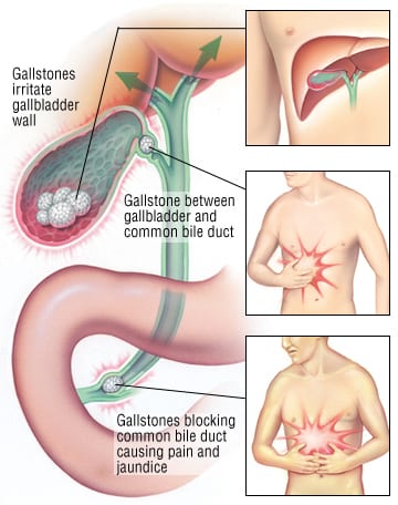 Patient Basics Gallstones 2 Minute Medicine