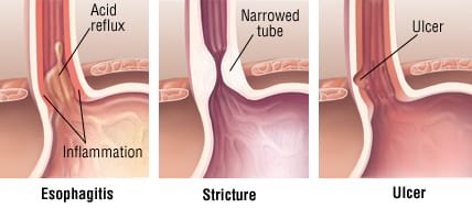 Patient Basics: Gastroesophageal Reflux Disease (GERD) | 2 ...