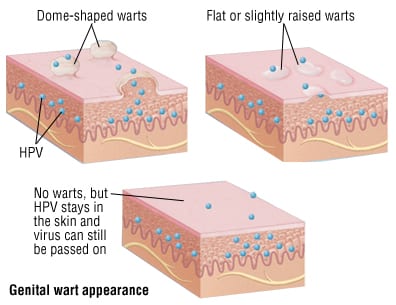 Patient Basics Genital Warts 2 Minute Medicine