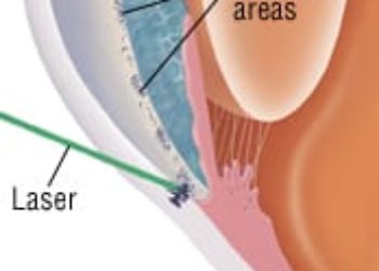 Patient Basics: Glaucoma